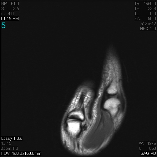 Figure 2 for case Stener lesion